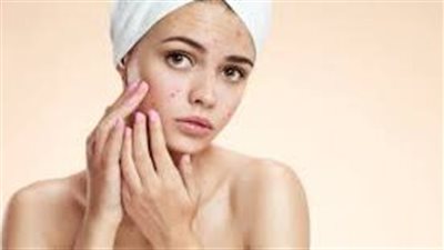 ما هي المأكولات التي تسبب في ظهور حب الشباب