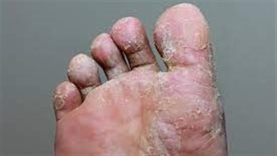 فطريات القدم: إليك أسبابها وطرق علاجها