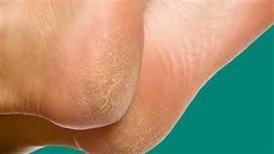 تنظيف كعب الرجل الجاف المتشقق