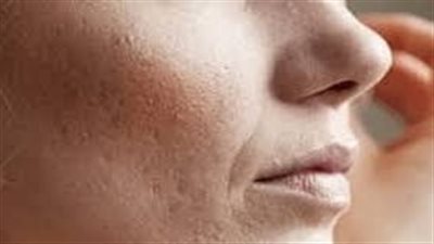 وداعاً للندوب: طريقة إزالة الندوب من الوجه