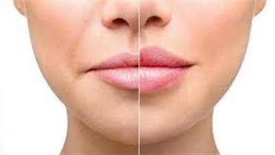حقن الفيلر: متى تتوقعين النتائج؟
